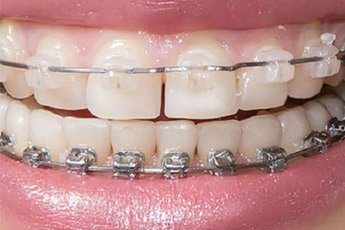 Ortodonti Bostanlı Izmir |  Braketler