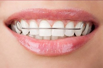 Ortodonti Bostanlı Izmir | Diğer Apareyler
