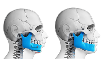 Ortodonti Bostanlı Izmir | Ortognatik Cerrahi